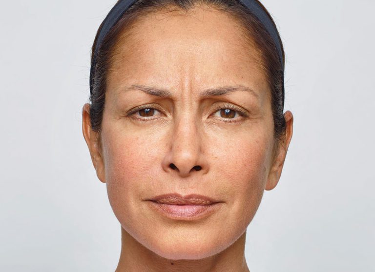 Botox Result Asheville