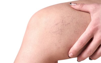 Understanding Spider Veins: What They Are and Why You Should Seek Treatment