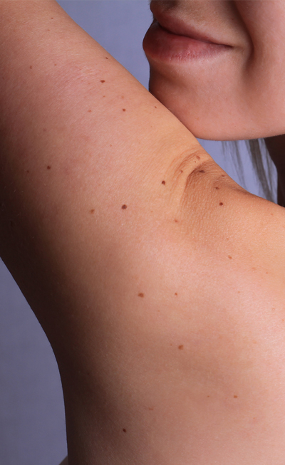 Photo of a woman's shoulder with sun spots and brown spots