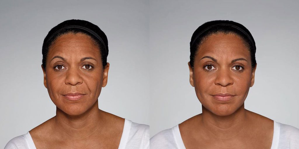 Dermal Fillers Before and After Photo by Harpe Laser & Wellness in Asheville NC