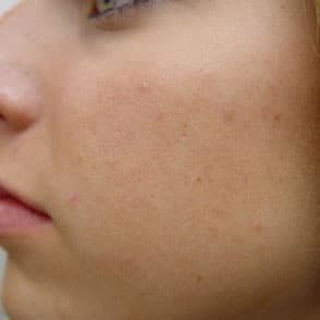Dermaplaning After Photo by Harpe Laser & Wellness in Asheville NC