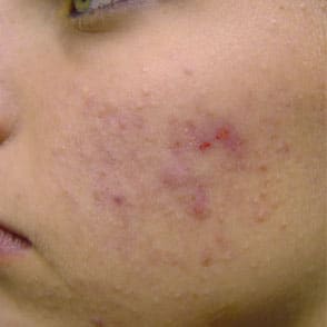 Dermaplaning Before Photo by Harpe Laser & Wellness in Asheville NC