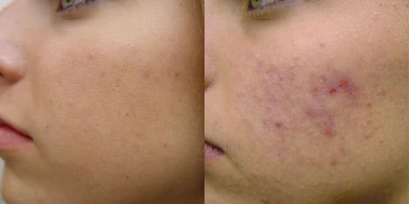 Dermaplaning Before and After Photo by Harpe Laser & Wellness in Asheville NC