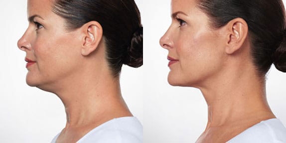 Kybella Before and After Photos by Harpe Laser & Wellness in Asheville NC