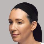 ba-filler-1-after 02 Dermal Fillers After Photo by Harpe Laser & Wellness in Asheville NC
