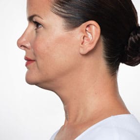 Kybella Before Photo by Harpe Laser & Wellness in Asheville NC