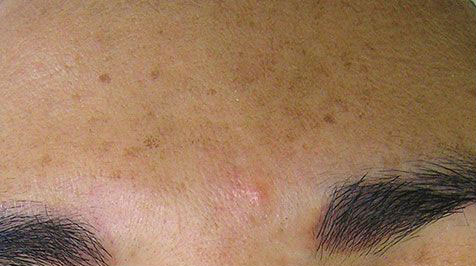 Dermaplaning Before Photo by Harpe Laser & Wellness in Asheville NC