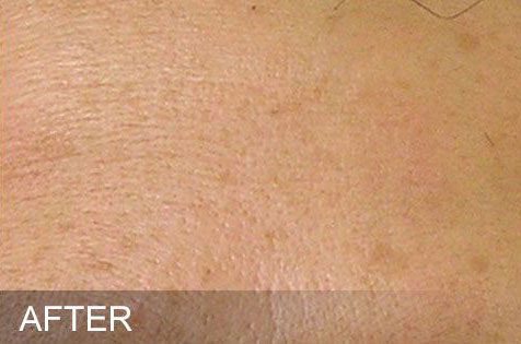 Hydrafacial before photo by Harpe Laser & Wellness in Asheville NC