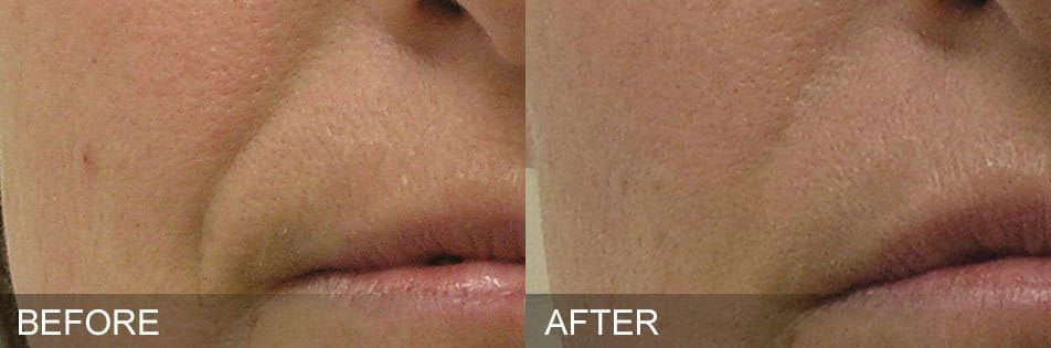 Hydrafacial before after NasolabialFolds by Harpe Laser & Wellness in Asheville NC