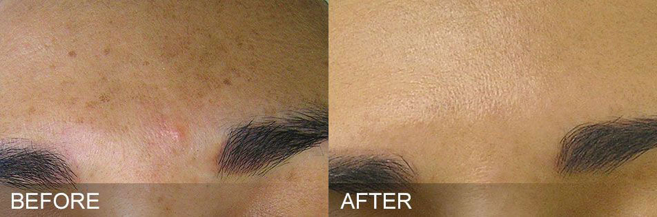 hydrafacial before and after Brown Spots treatment by Harpe Laser & Wellness in Asheville NC