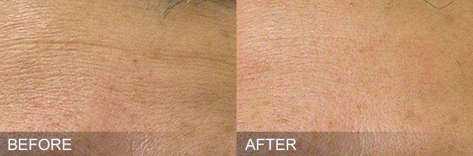 Hydrafacial before and after Fine Lines treatment by Harpe Laser & Wellness in Asheville NC