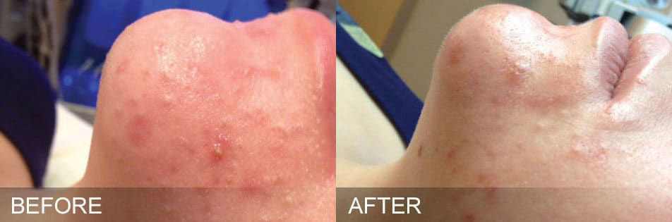 hydrafacial before and after oily congested by Harpe Laser & Wellness in Asheville NC