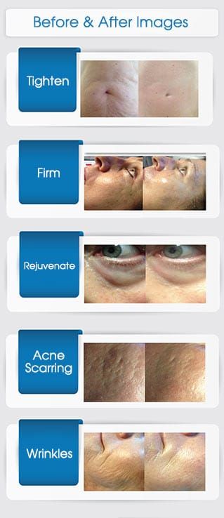 Rejuvapen Before and After Photo by Harpe Laser & Wellness in Asheville NC