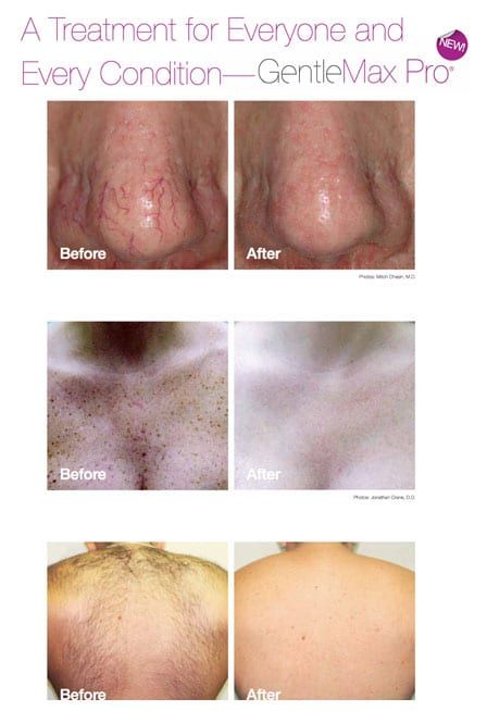GentleMax Pro Before and After Photo by Harpe Laser & Wellness in Asheville NC