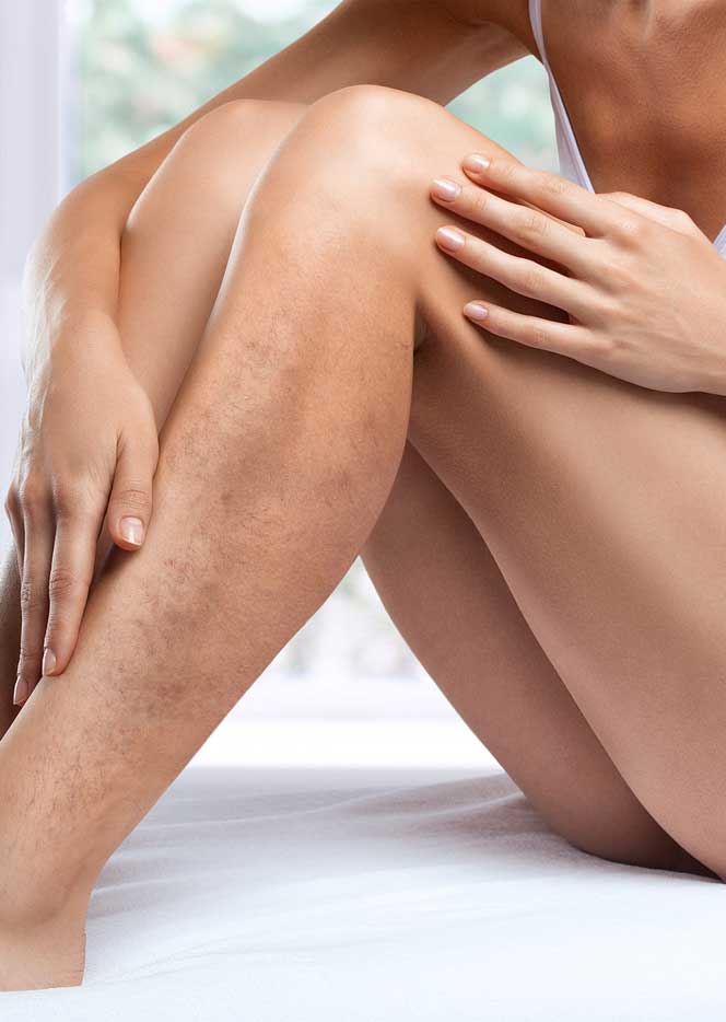 Beautiful-Slender-Woman-Sits-O-438627530sm Photo of a patient's leg undergoing laser vein removal