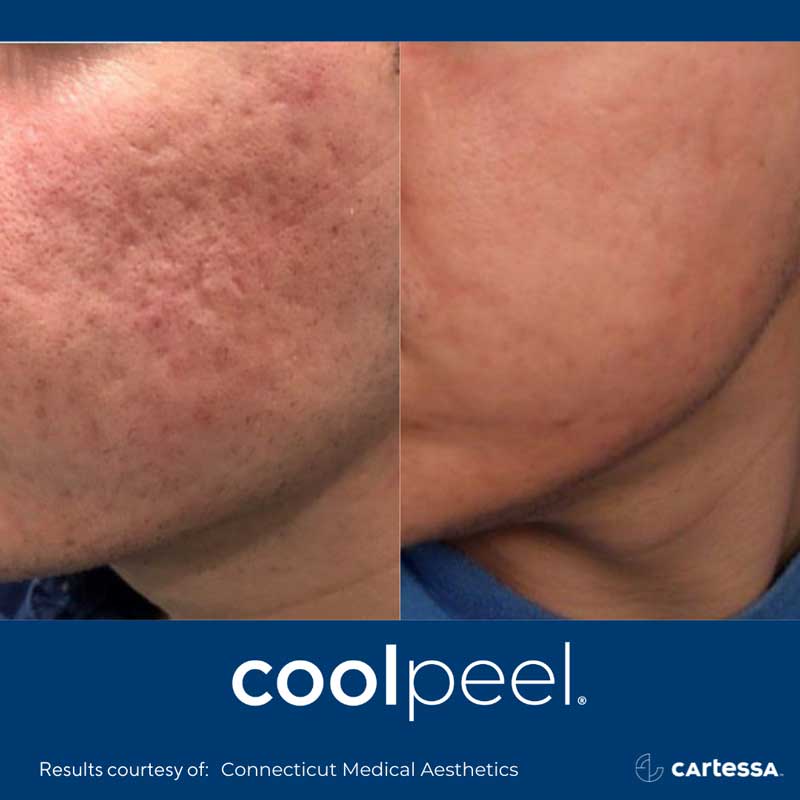 CoolPeel Before and After