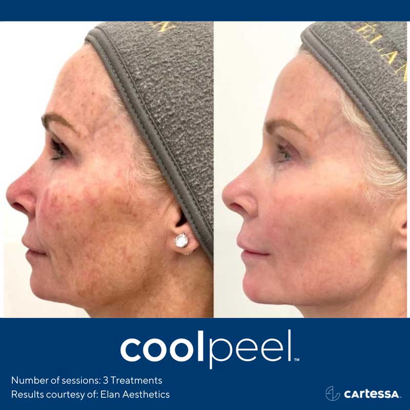 CoolPeel Before and After