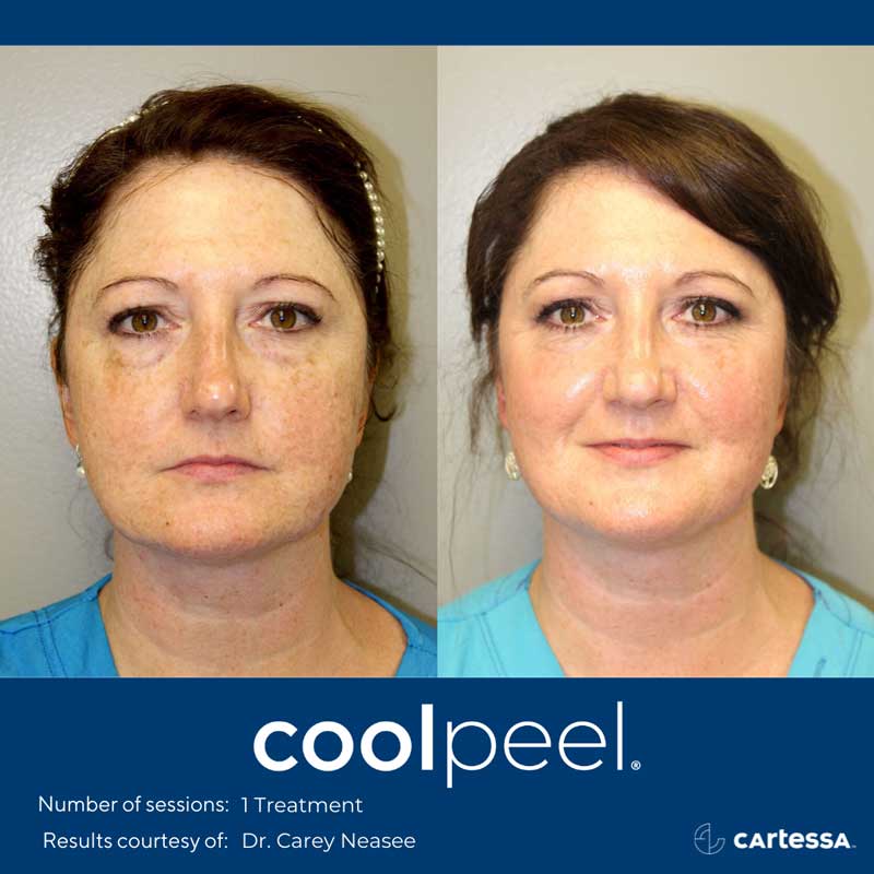 CoolPeelBAFemaleFaceFront CoolPeel Before and After