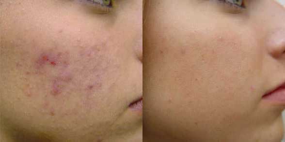 Dermaplaning Before and After Photo by Harpe Laser & Wellness in Asheville NC