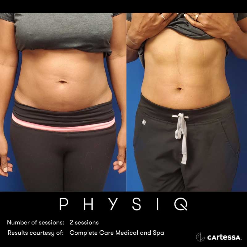 Physiq Body Contouring Laser Body Sculpting in Hendersonville
