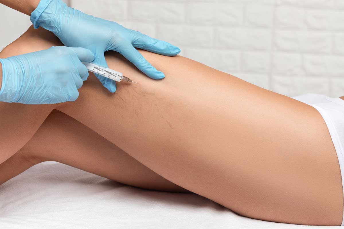 Removal-Of-Varicose-Veins-On-T-434213660