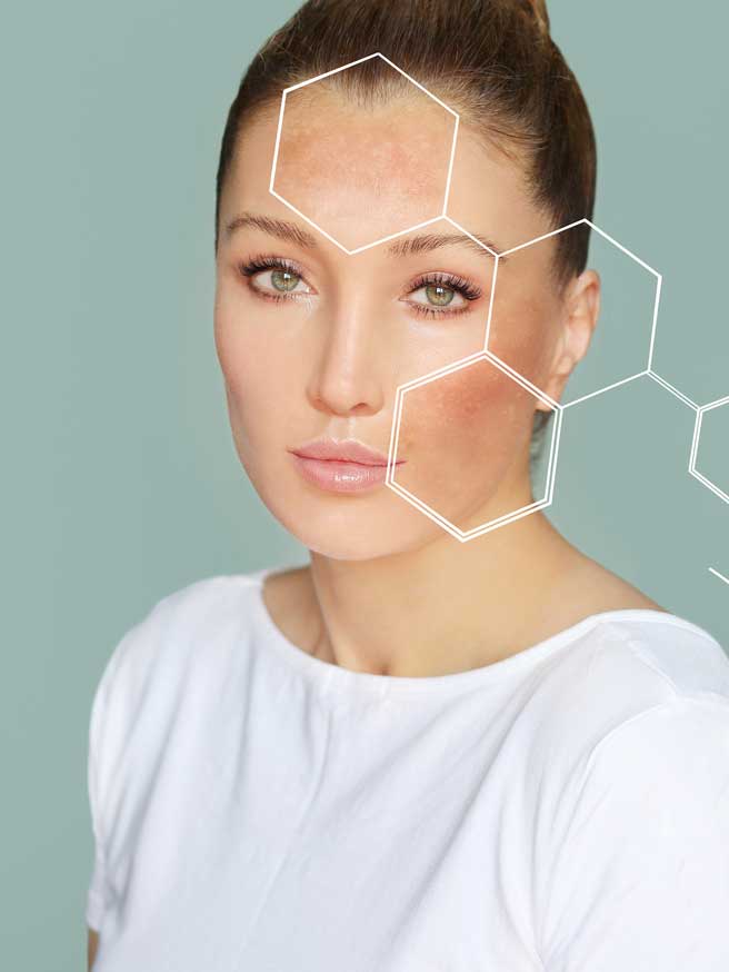 Sun-Spot-Removal Sun Spot removal Hendersonville