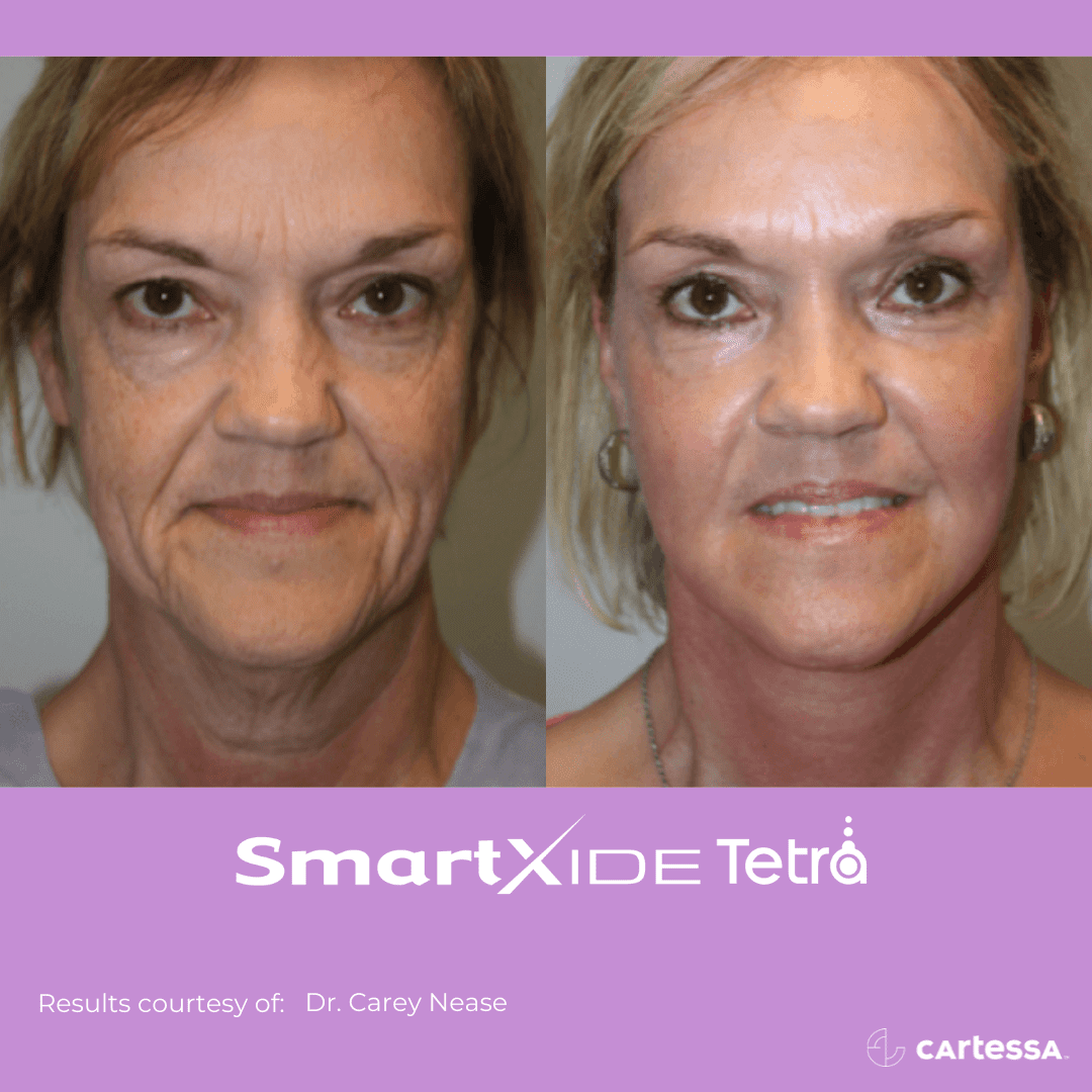 TetraBAFemaleFace Before and After Result - Tetra CO2 Cool Peel Laser