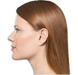 Kybella After