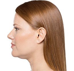 Kybella Before