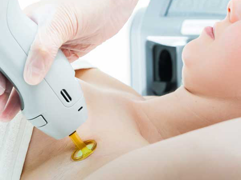Unveiling the Science: How Laser Hair Removal Works