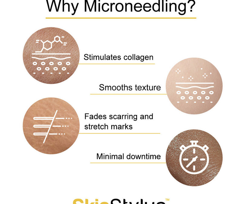 What to Expect from Radio Frequency Microneedling Treatment?